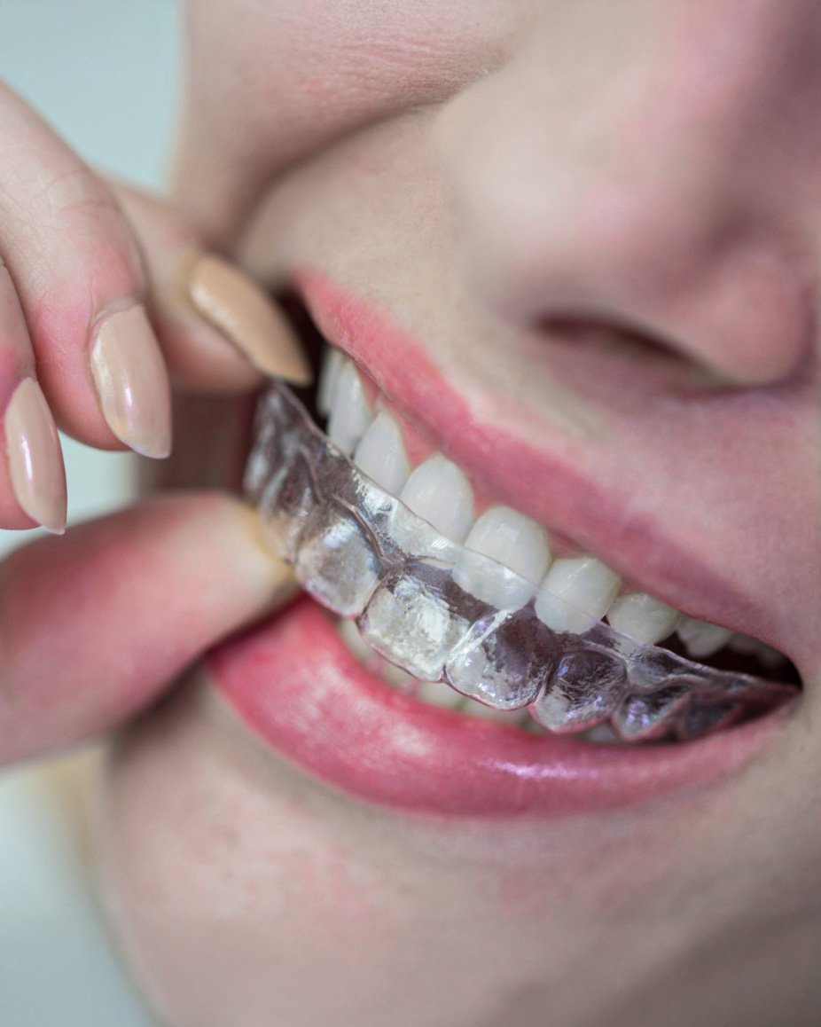 Ortodoncia invisible vs. brackets tradicionales: ¿cuál es la mejor opción para ti?